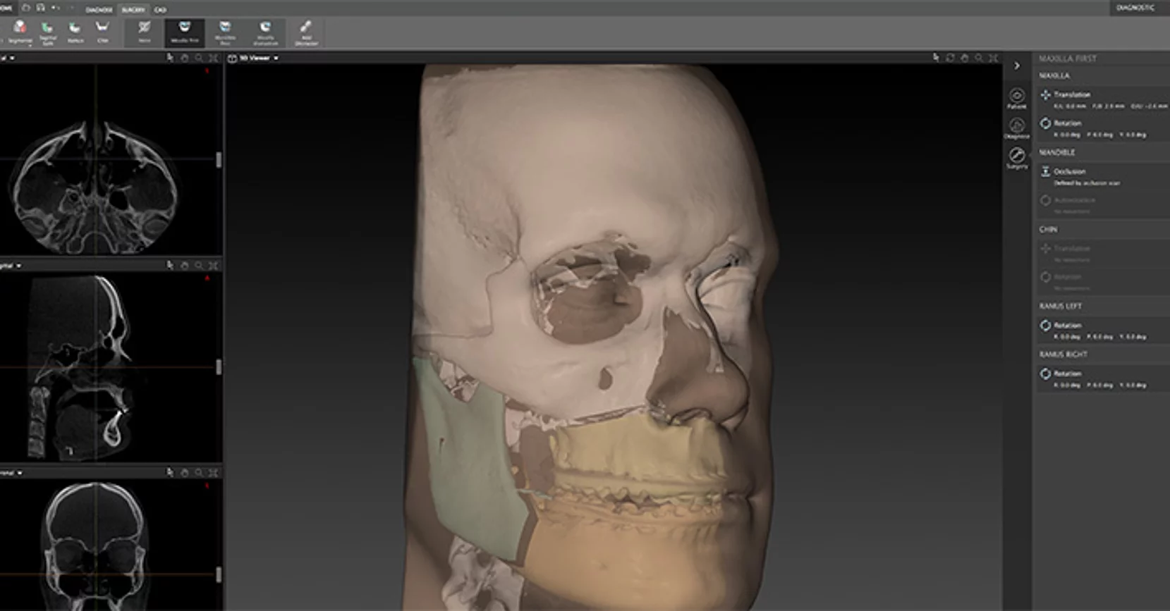 Patientenspezifische Implantate IPS Implants®