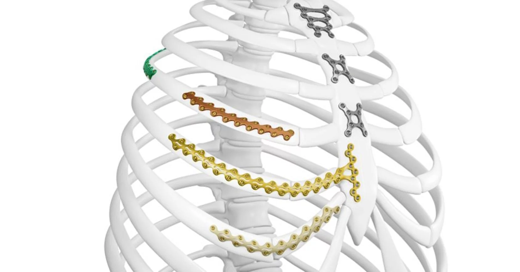 Système de fixation thoracique L1® Rib