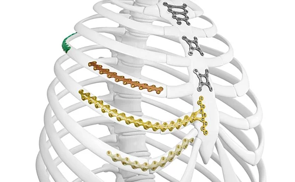 L1 Rib Thorax-Fixationssystem