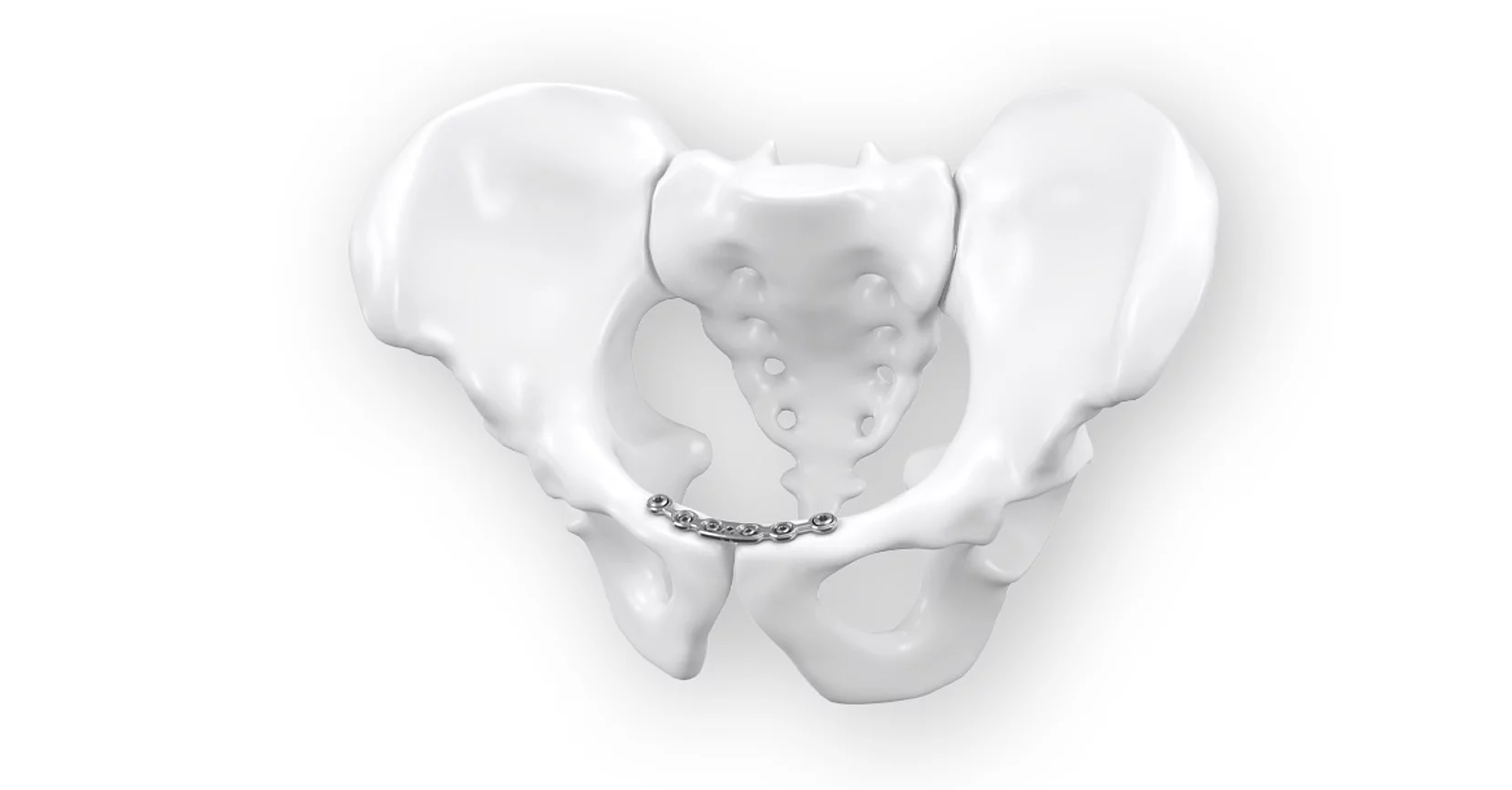 Plaques Nexos Pelvis I, C et J