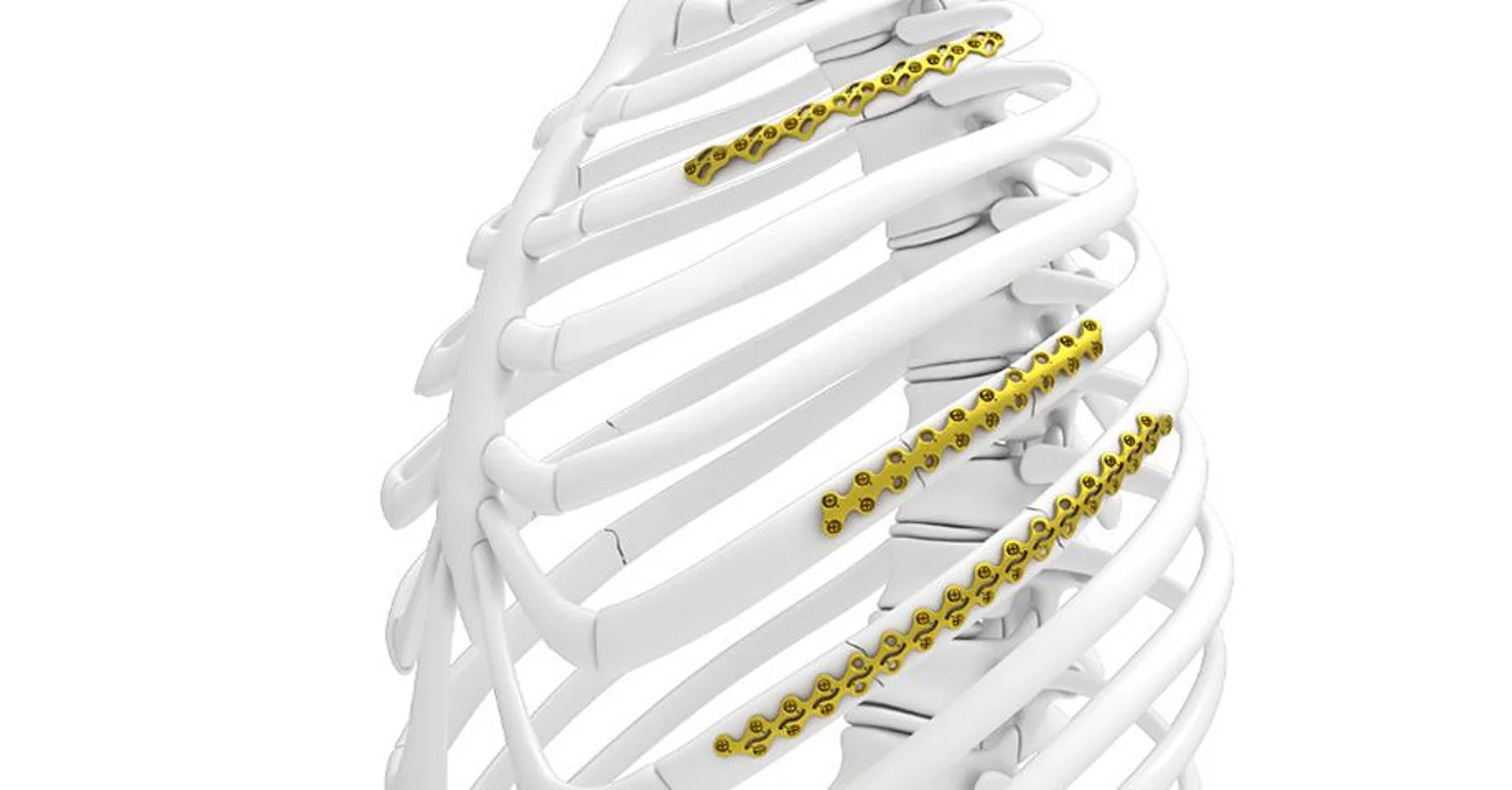 Thorax-Fixationssystem L1® Rib