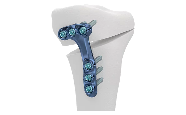 Gamme Ostéotomie