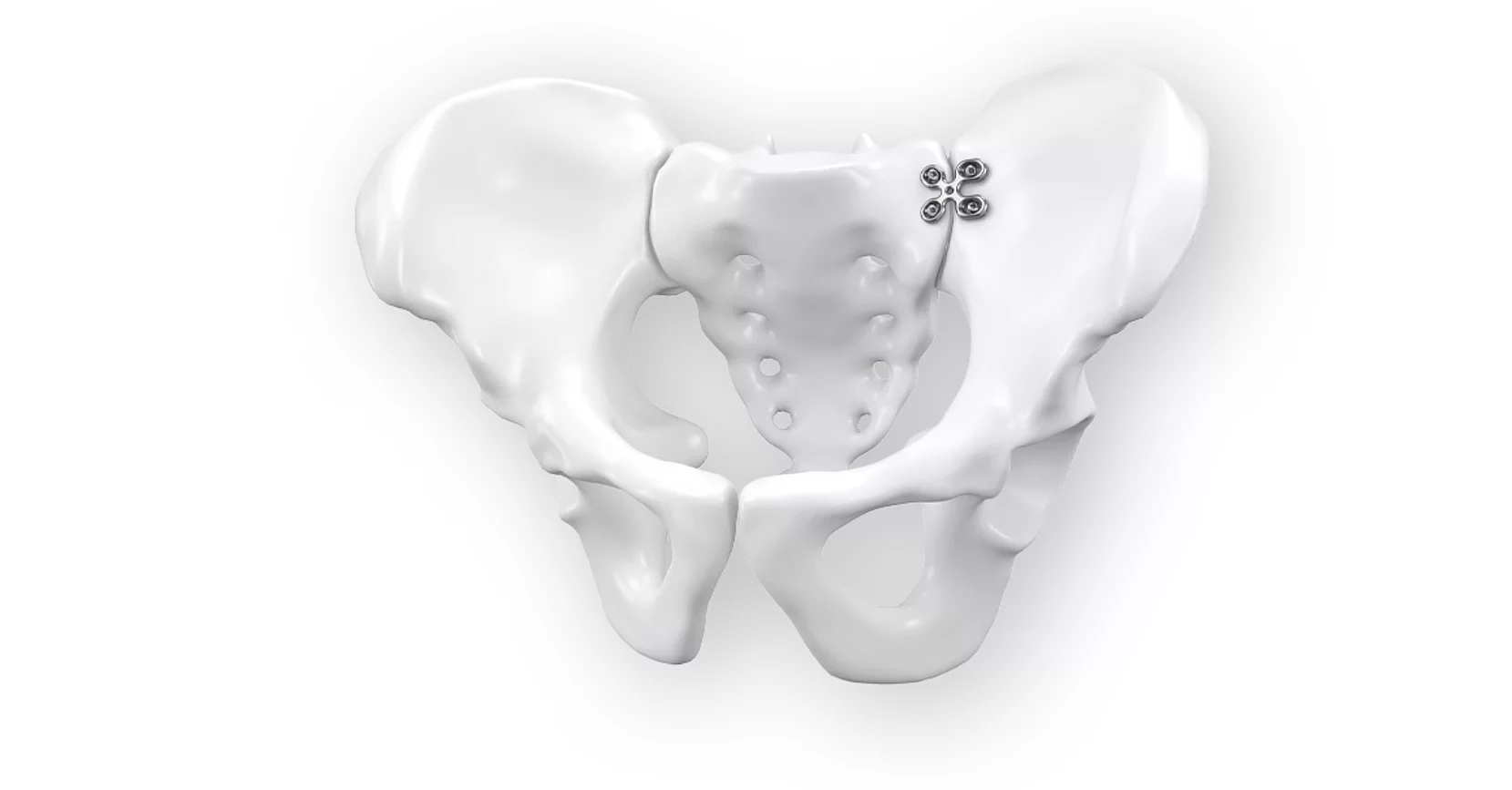 Plaques X Nexos Pelvis