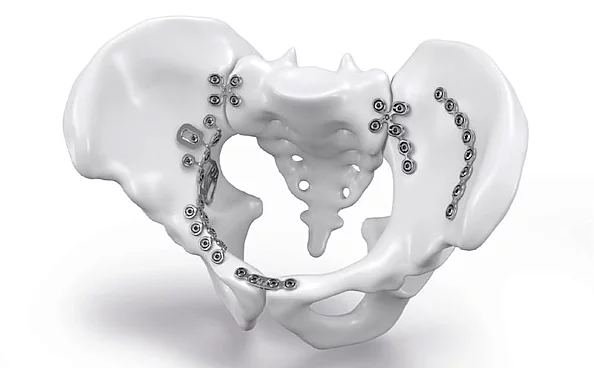Système d'ostéosynthèse Nexos Pelvis