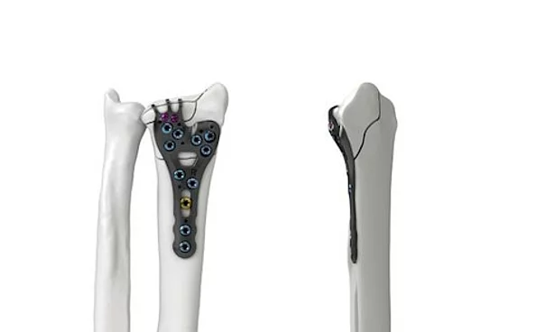 Radiusplattensystem Ixos® Radiusplattensystem Ixos®