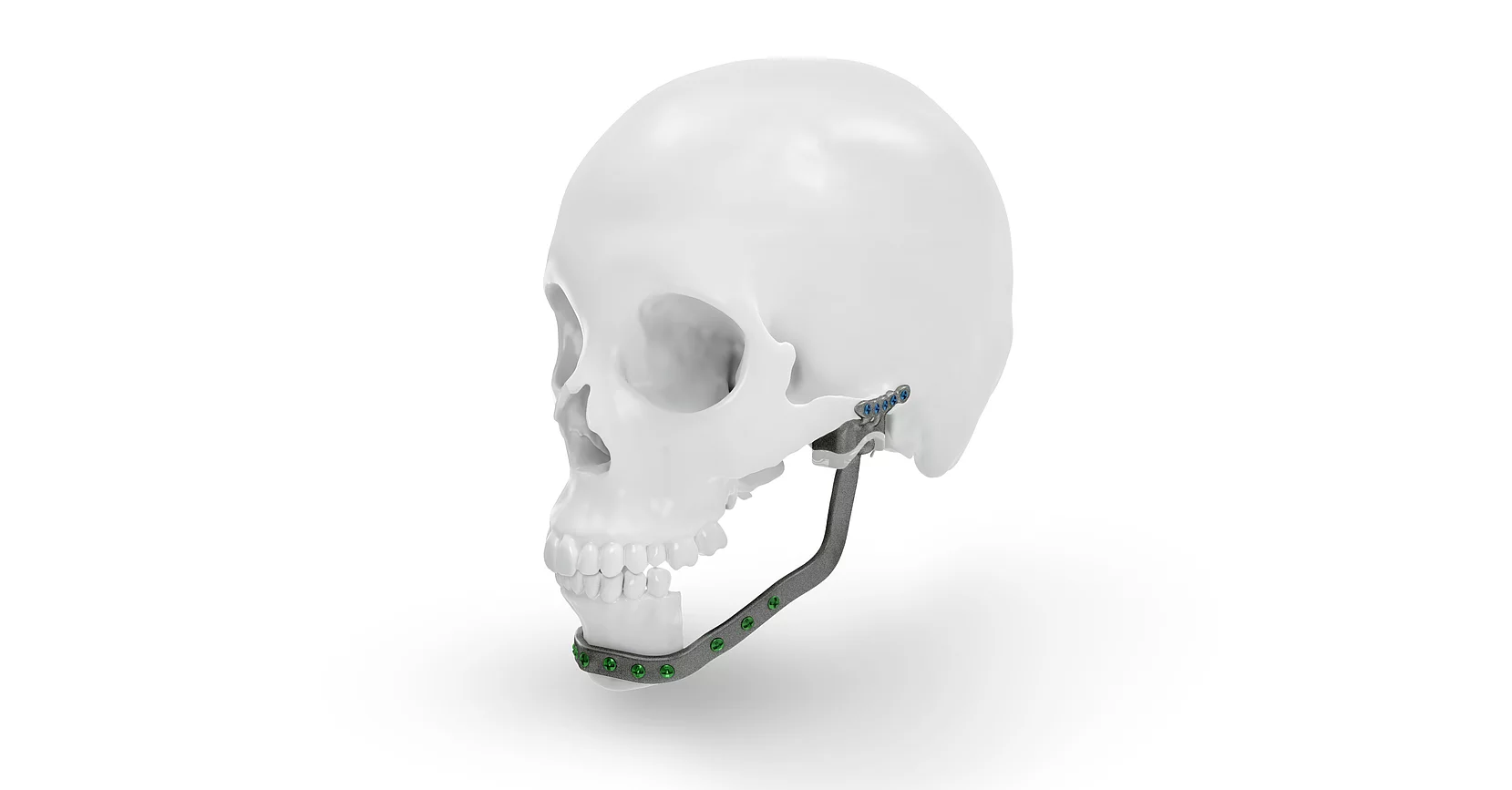 IPS Implants TMJ-Prothese