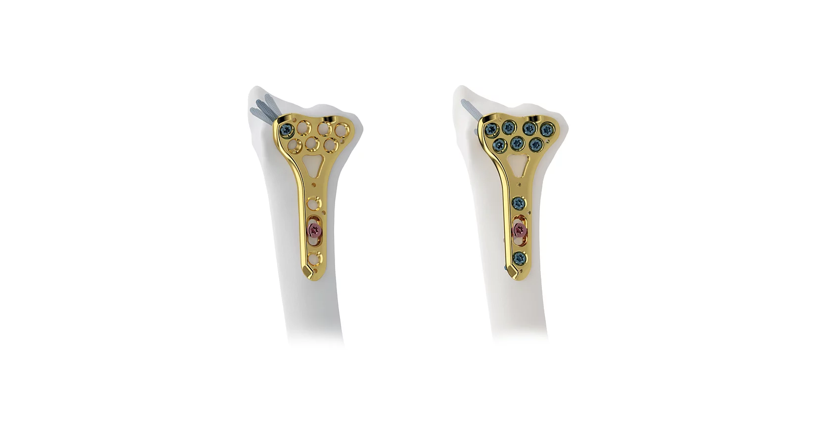 Wristar MultiAx: Steriles Komplettsystem für die distale Radiusversorgung