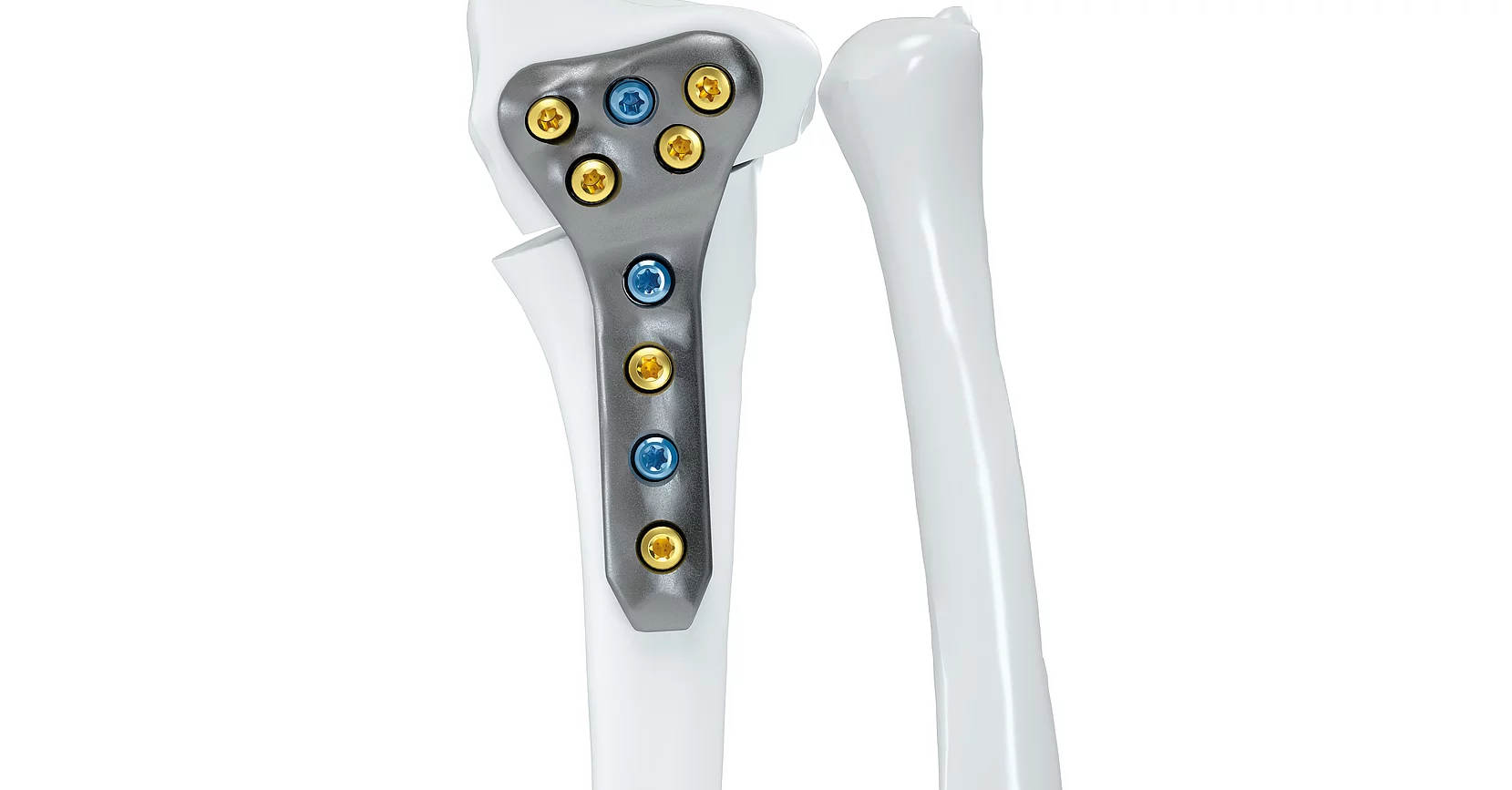 Patientenspezifisches Implantate IPS Implants® Patientenspezifisches Implantate IPS Implants®