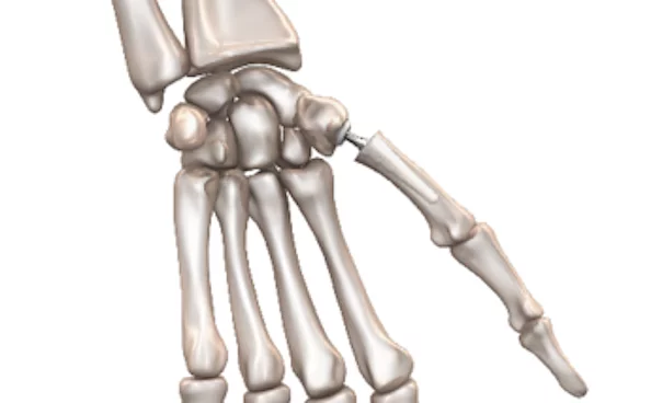 Daumensattelgelenksprothese MAÏA™