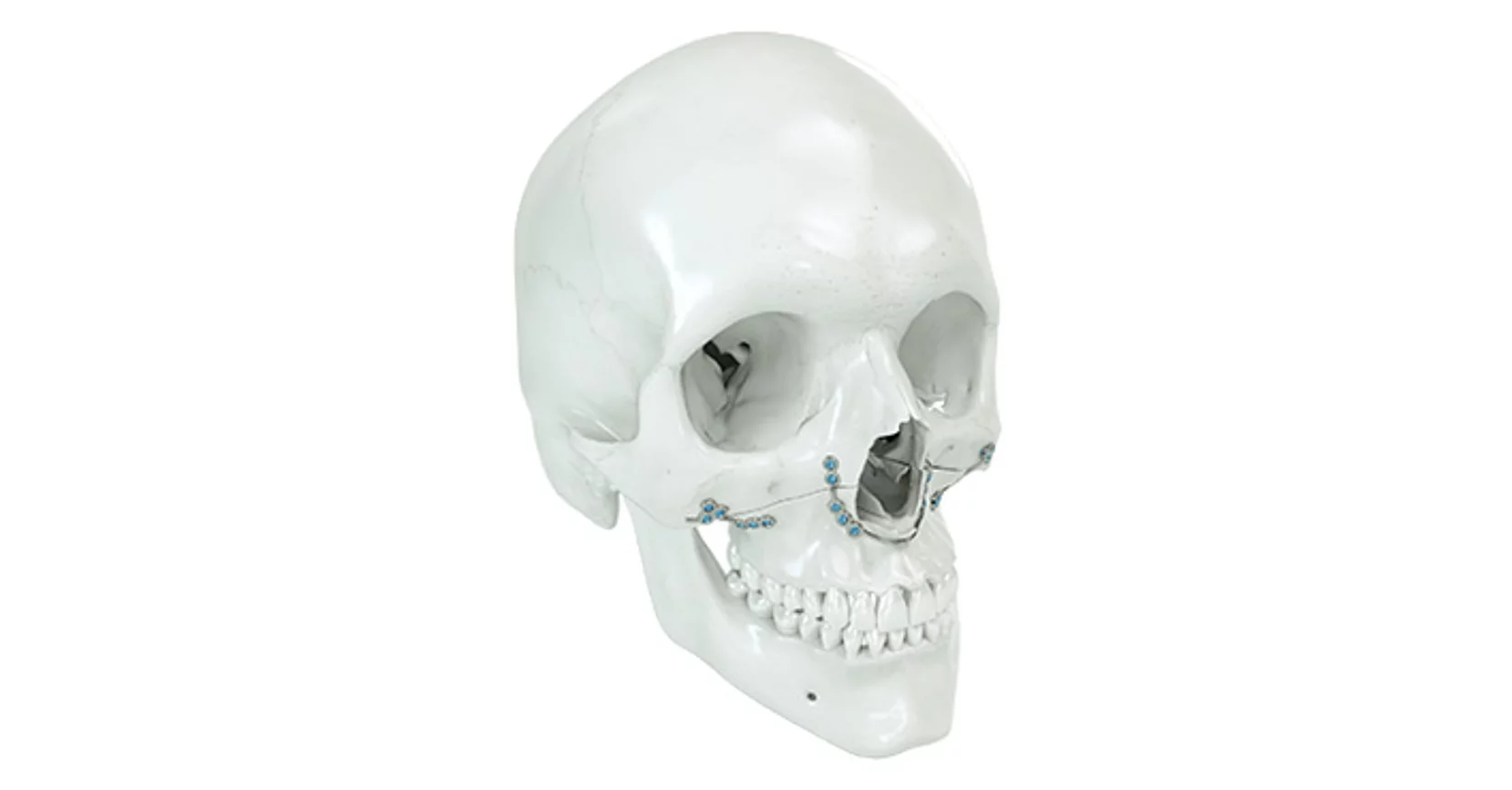 Patientenspezifische Implantate IPS Implants®