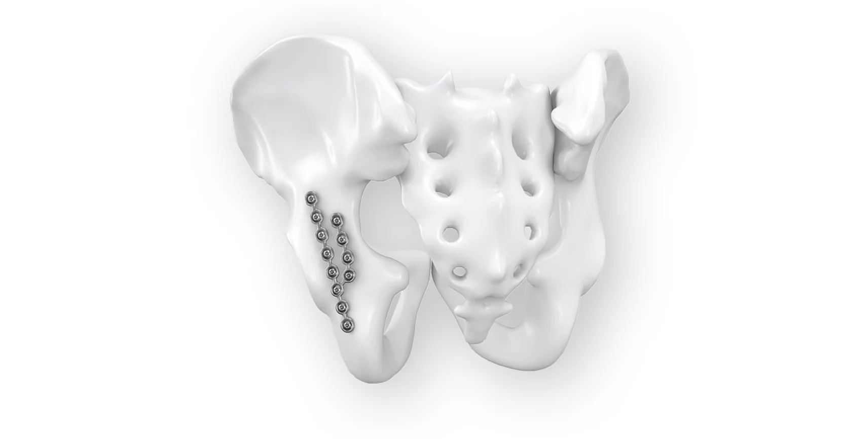 Plaques en Y Nexos Pelvis