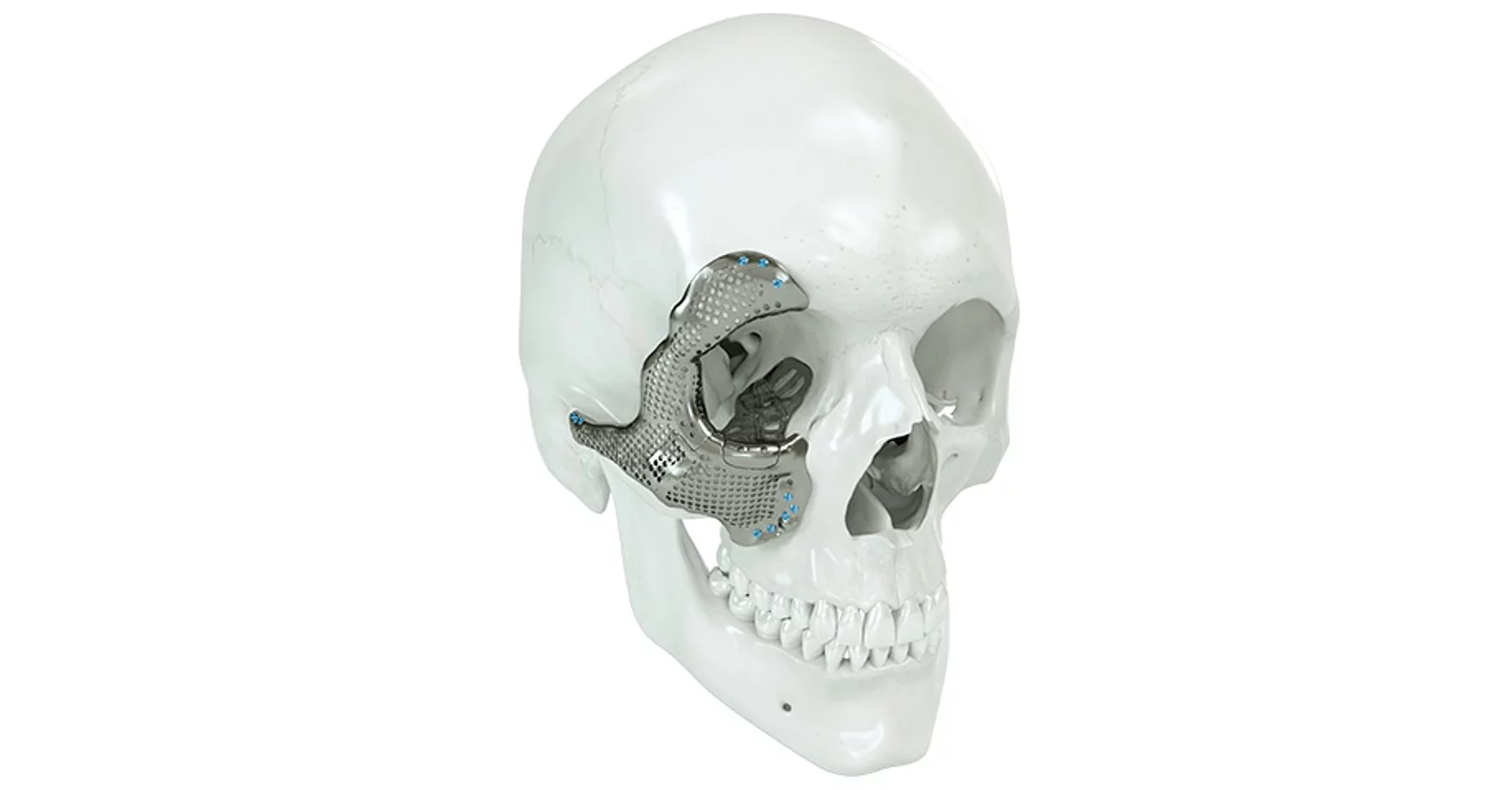 Patientenspezifische Implantate IPS Implants®