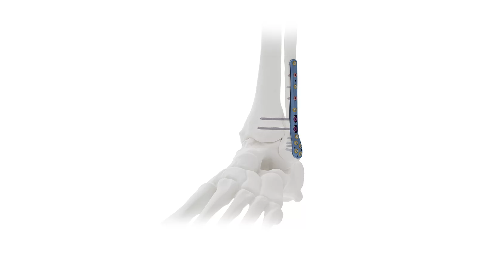 Kite : solution complète stérile pour le péroné distal